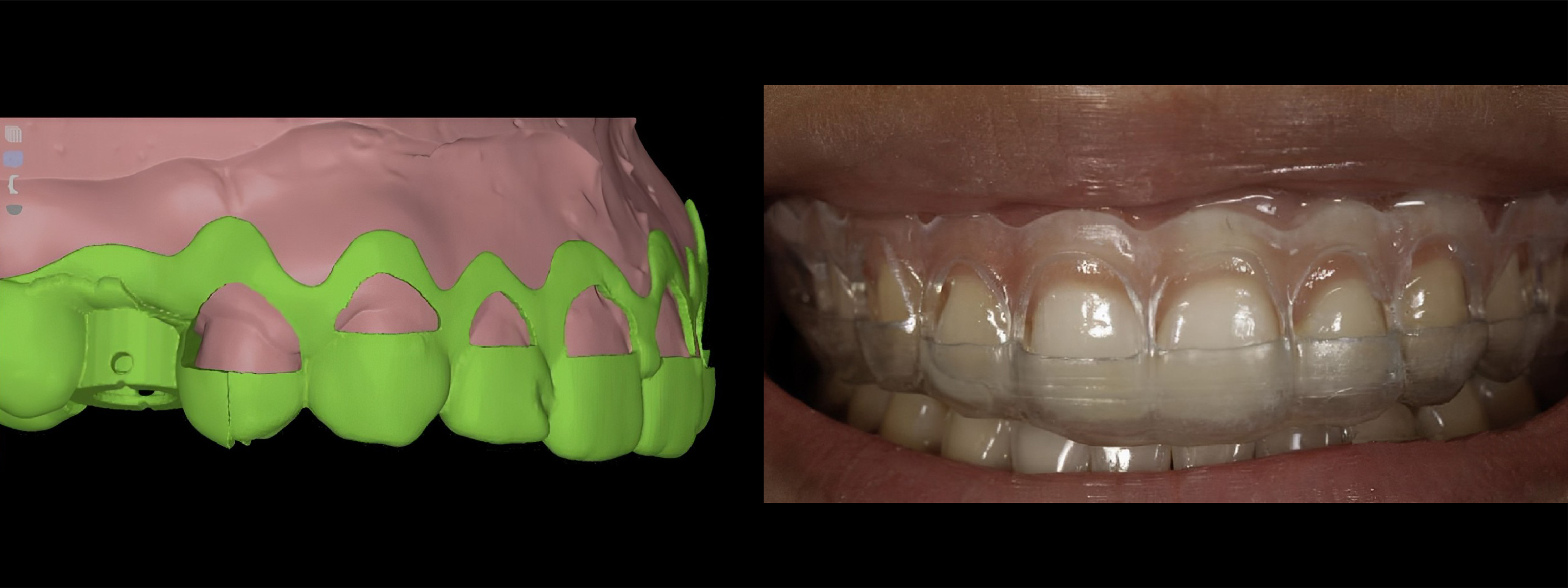 Radiografía Intrabucal